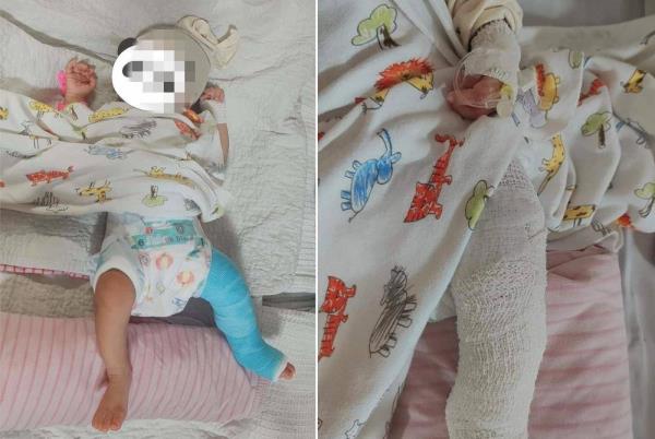 两个月大的婴儿腿骨折，据称被保姆虐待